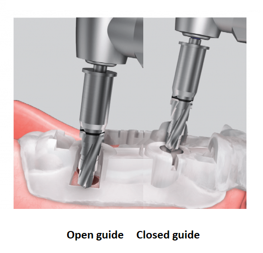 Osstem-ohjainkirurgia - OneGuide ohjurin hyödyt