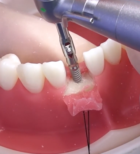 Osstem MS System - mini-implantit