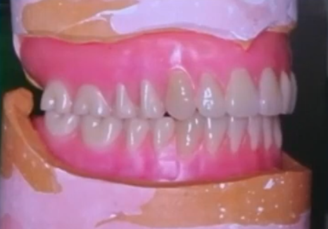 Peittoproteesien kiinnitys hammasimplanteilla